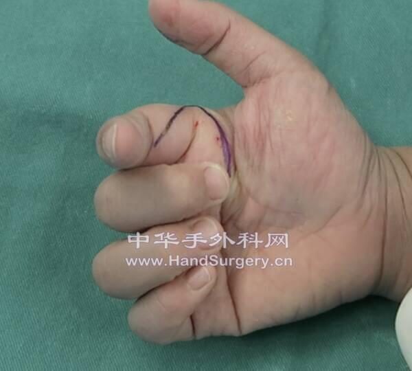 术前屈指障碍