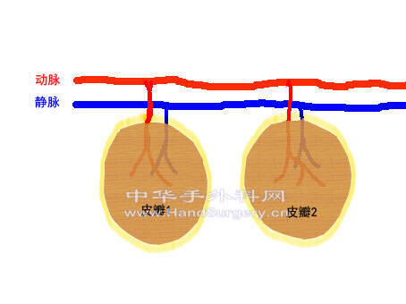 并联皮瓣.jpg