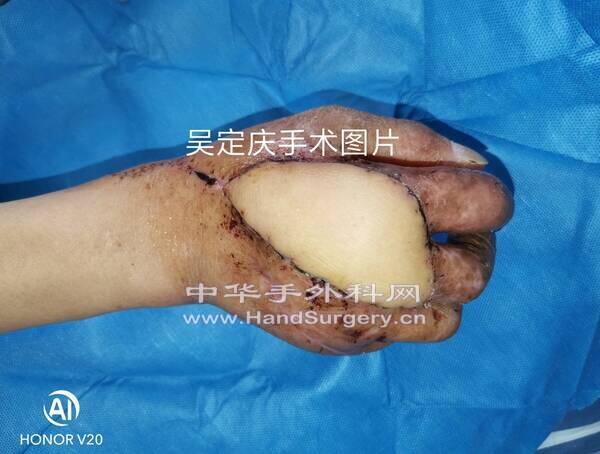 腓肠内侧动脉皮瓣术后1.jpg