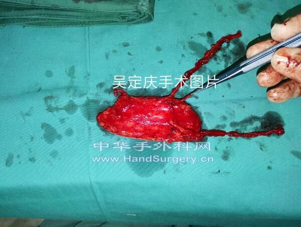 腓肠内侧动脉皮瓣术中3.jpg