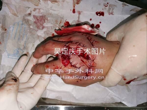 术后背侧.jpg