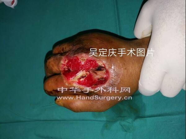 术后皮肤坏死.jpg