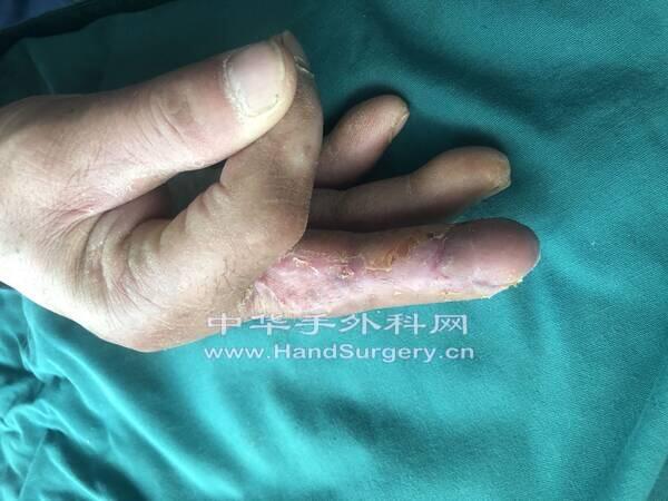复查感觉有恢复，岛状瓣时间短出院快，关节活动挺好