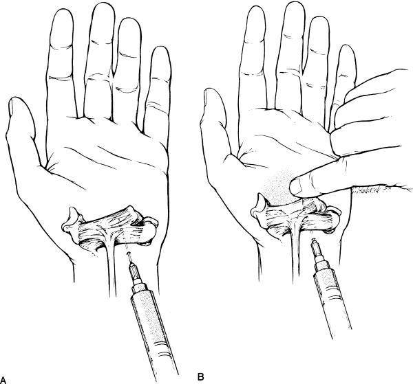 median nerve 2.JPG
