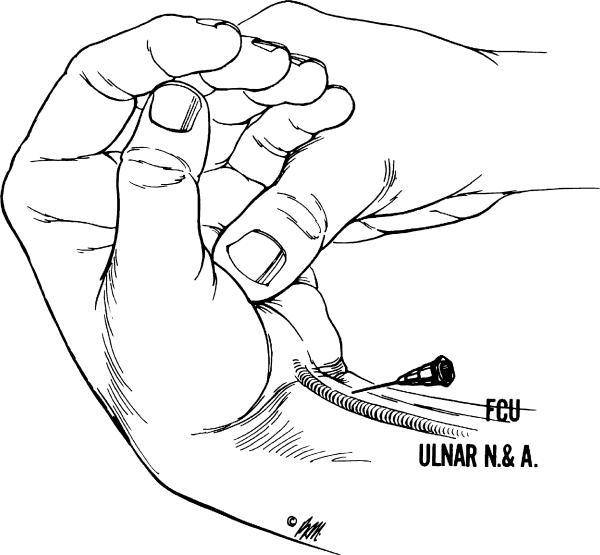 ulnar nerve.JPG