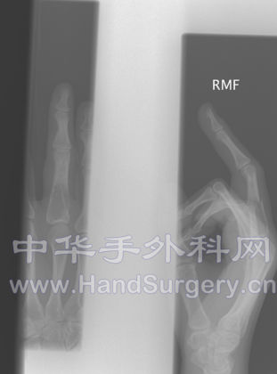 骨折当天正骨x光片