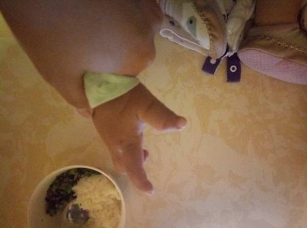 手术后2岁姆指侧弯