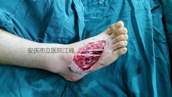 足背皮肤缺损