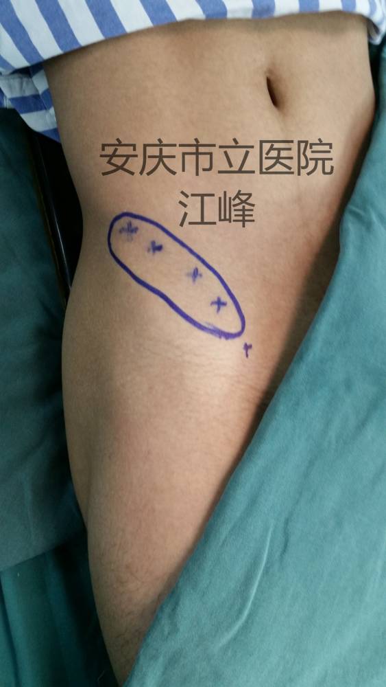 皮瓣的设计，术中要保护好股外侧皮神经