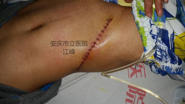 供区直接缝合术后