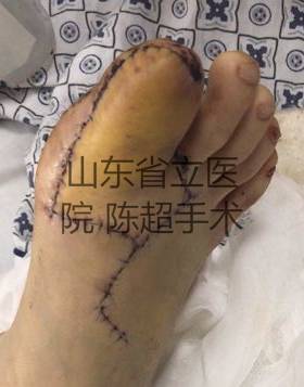 术后2周，病人出院，手机拍摄