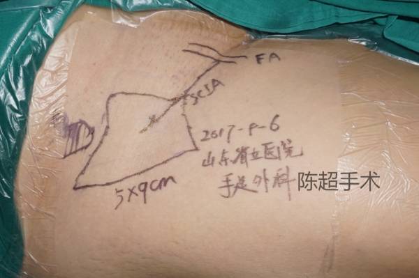 二期游离腹股沟皮瓣修复组织缺损