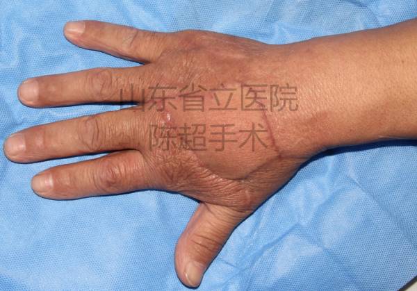 术后3个月患者复查