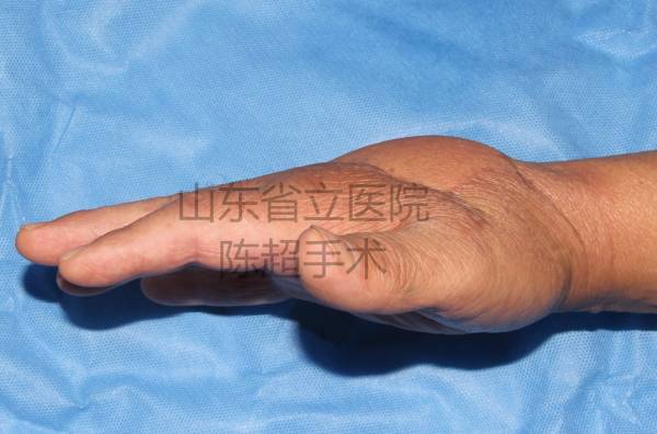 术后3个月患者复查