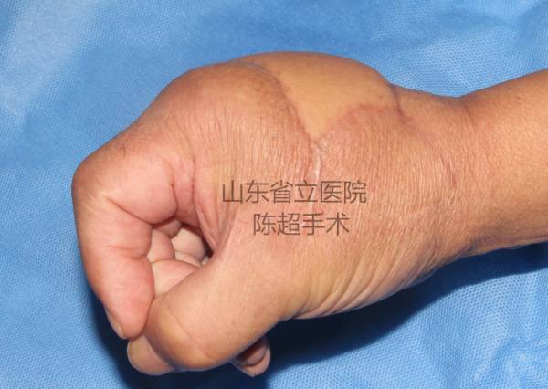 术后3个月患者复查