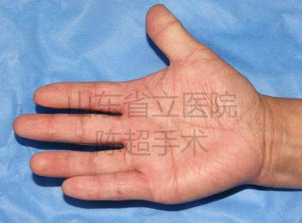 术后3个月患者复查
