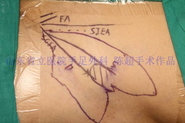 设计双侧游离旋髂浅动脉皮瓣