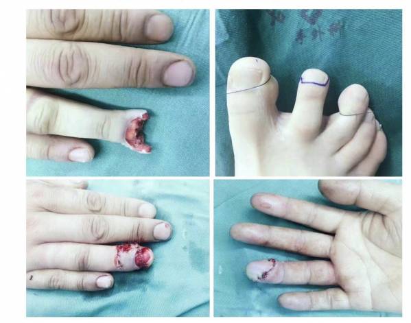 环指指端缺损，取第二趾再造