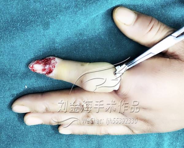 手指缺损