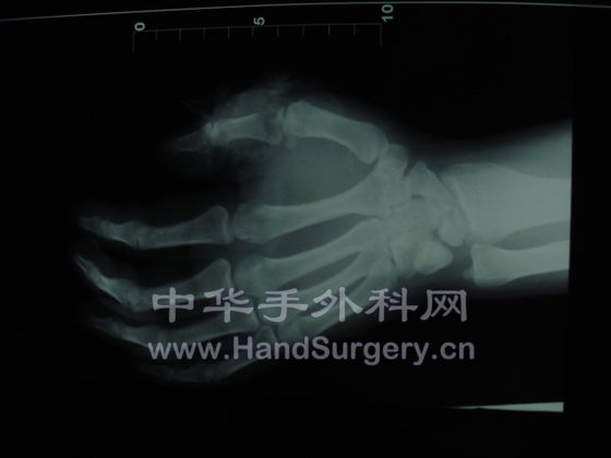 X线片1.JPG