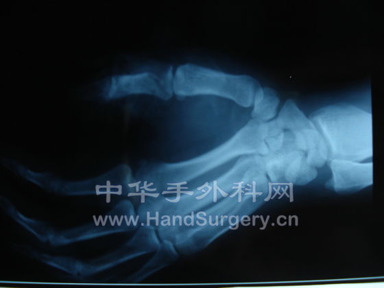 X线片2.JPG