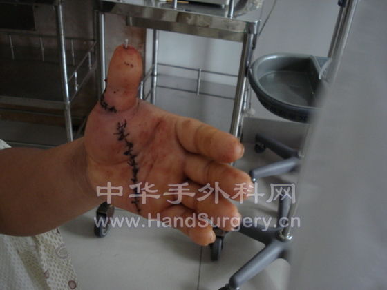 界哥的作品，术后2天