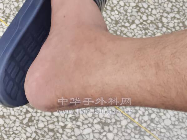 跟腱止点重建术后3个月外观