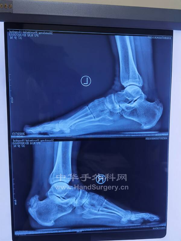 止点性跟腱炎DR