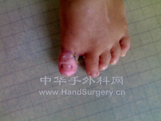 术后二个月照片.jpg