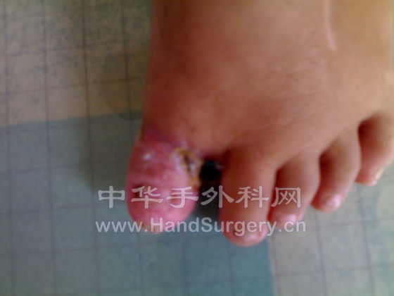 术后二个月照片 (2).jpg