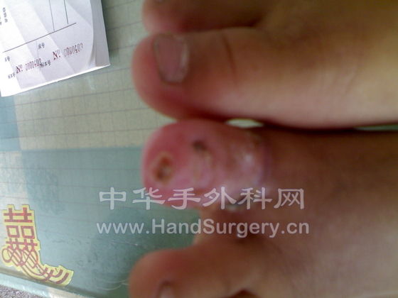 术后二个月照片 (5).jpg