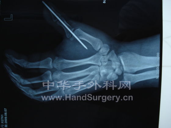 术后x线片