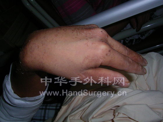 左手最大伸直度.JPG