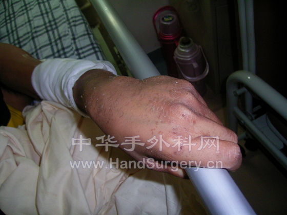 左手能紧握有力.JPG