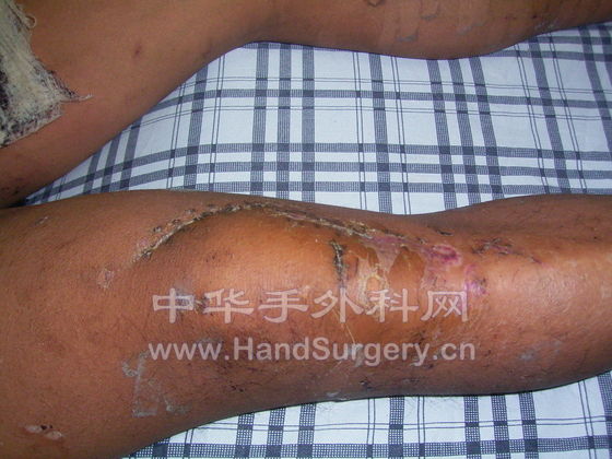 右腿伤口有些肿胀.JPG