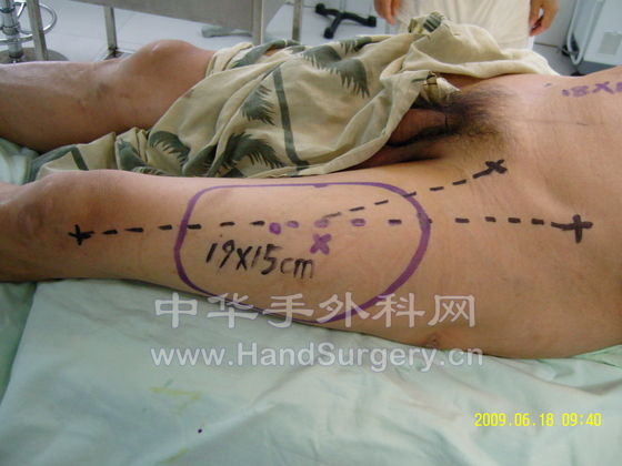 术前皮瓣设计1.jpg