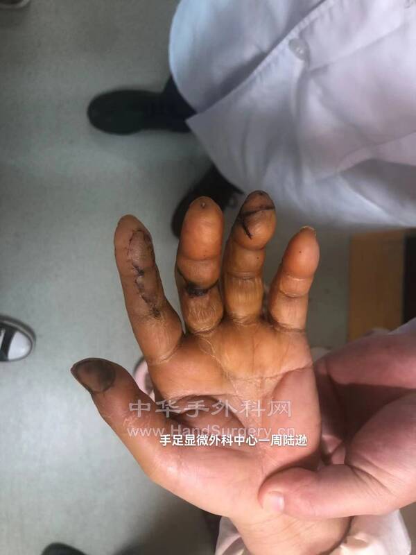 术后13天拆线