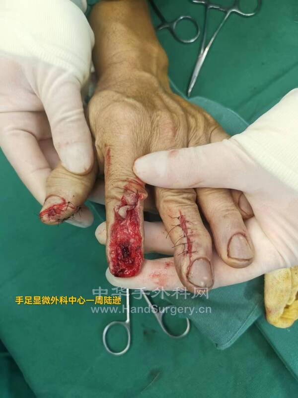 左手食指中远节指背缺损