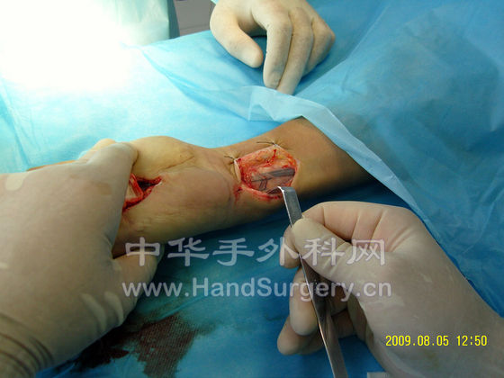 暴露尺动脉腕上分支.JPG