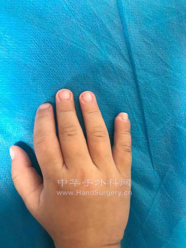 术后2个月