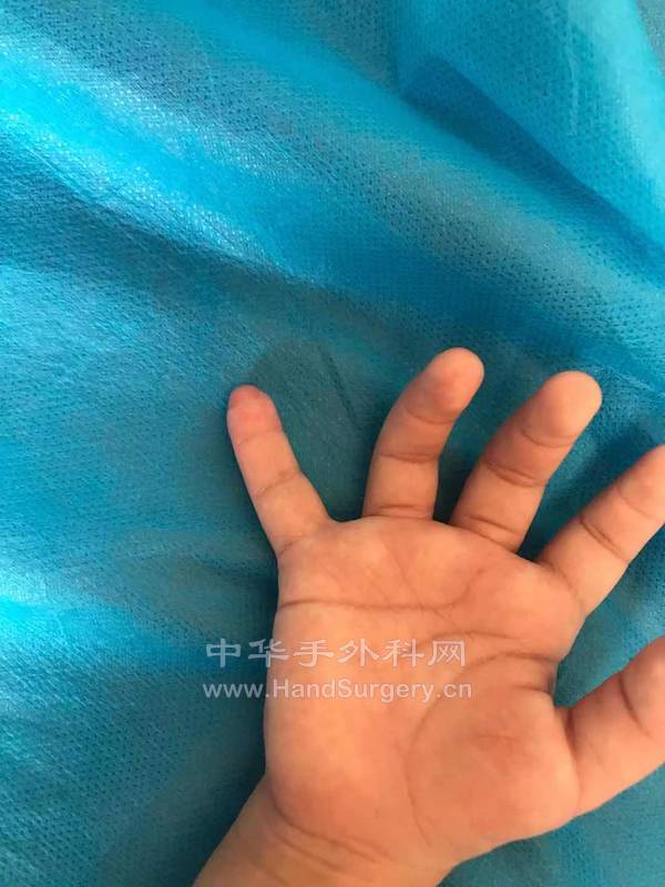 术后2个月