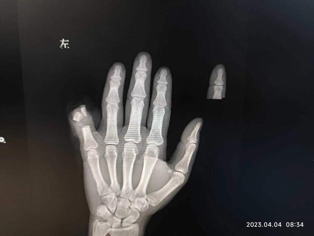 补充急诊X线