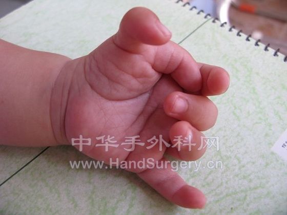 拇指内扣