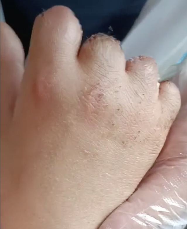 术前4个手指缺损