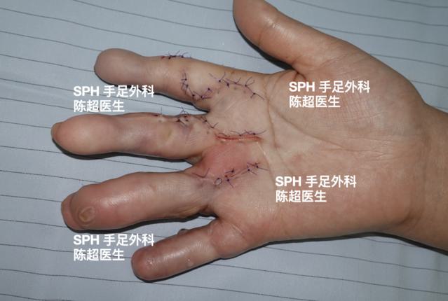 再造4个手指