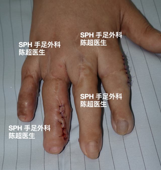 再造4个手指