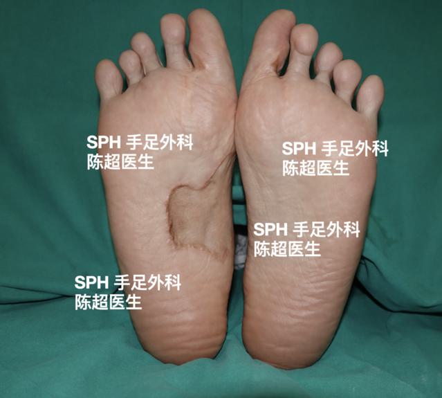 足趾全部保留