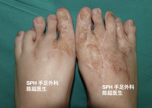 足趾全部保留