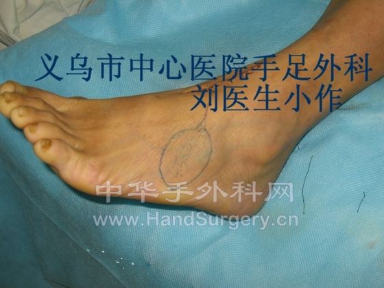 跗外侧游离皮瓣修复手指缺损设计.JPG