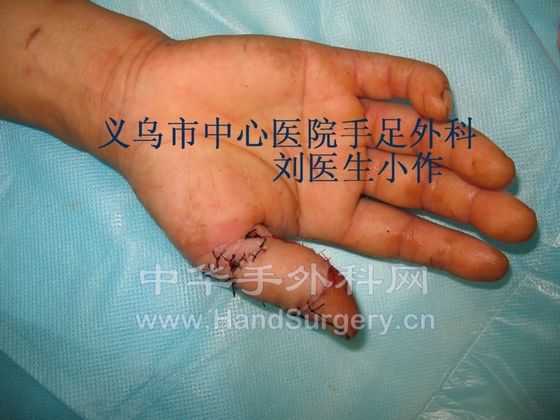 跗外侧游离皮瓣修复手指缺损术后.JPG